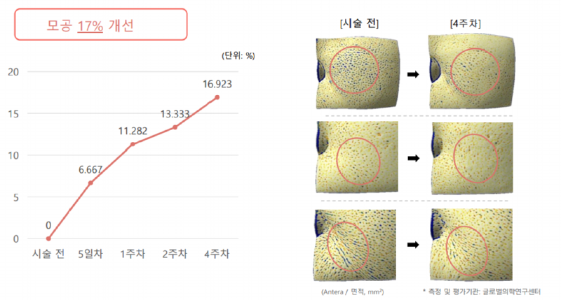 모공 17% 개선