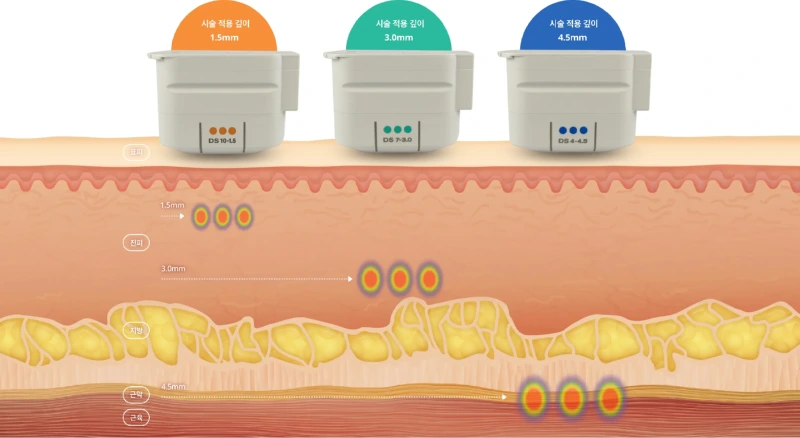 울쎄라피 프라임