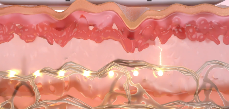 울쎄라 효과.png